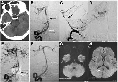 Optical Coherence Tomography of Spontaneous Basilar Artery Dissection in a Patient With Acute Ischemic Stroke